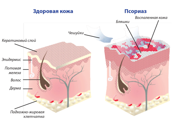 Не дай псориазу победить!