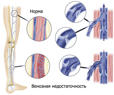 Нормовен – эффективная помощь вашим сосудам!