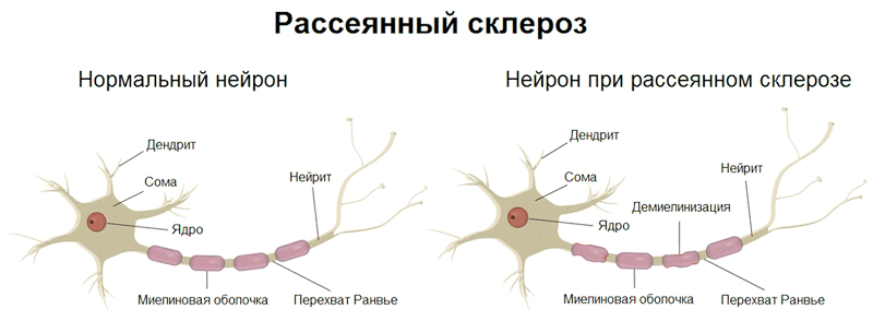 Рассеянный склероз: нерешенные проблемы и современные подходы в диагностике и лечении
