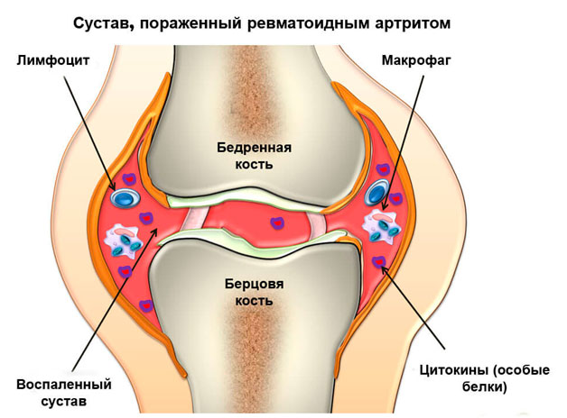 Боль в суставах – сезонная проблема осени