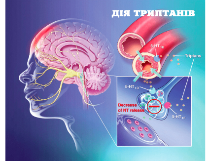 Стопмiгрен — ефективне лiкування нападу мiгренi