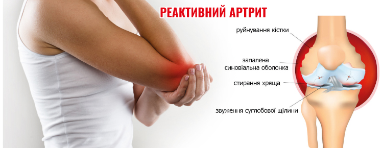 Імунологічні особливості пацієнтів з Постковідним синдромом
