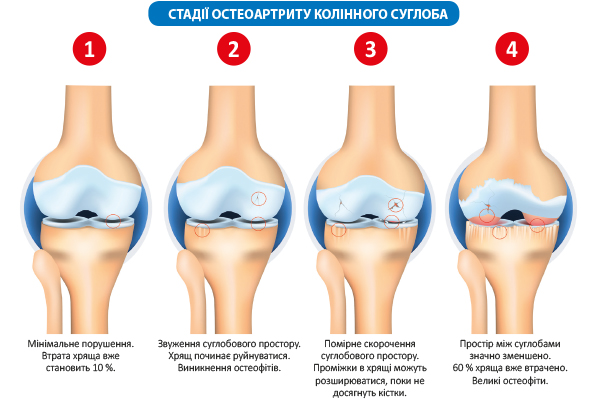 Прогресивний спосіб допомоги суглобам при остеоартриті/остеоартрозі