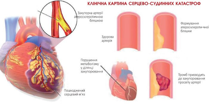 АЦЕКОР КАРДІО® - оптимальний вибір антитромбоцитарної терапії для профілактики тромбоутворень