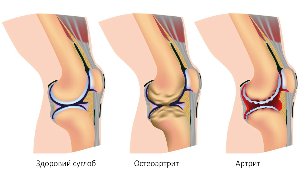 Терапевтичний алгоритм ведення пацієнтів з болем у суглобах: огляд сучасних міжнародних настанов, заснованих на доказах
