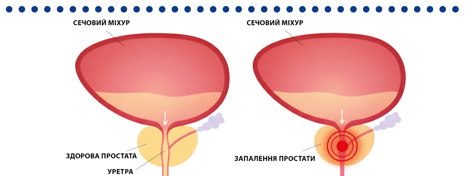Хронічні урологічні скарги у чоловіків: роль β-ситостеролу та β-глюканів в практиці фармацевта