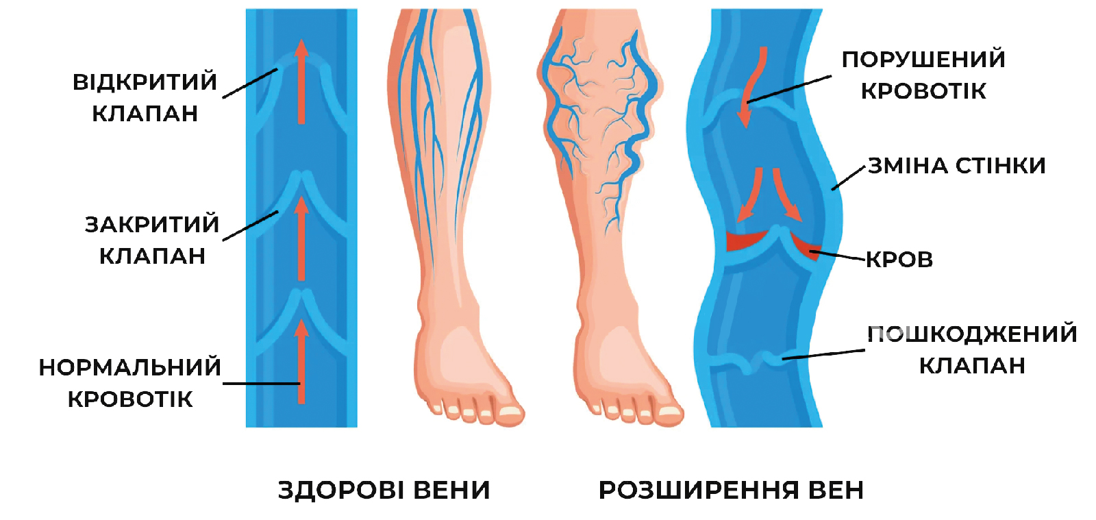 Синдром «втомлених ніг» місце ЕСКУЗАН® краплі у терапії венозних порушень