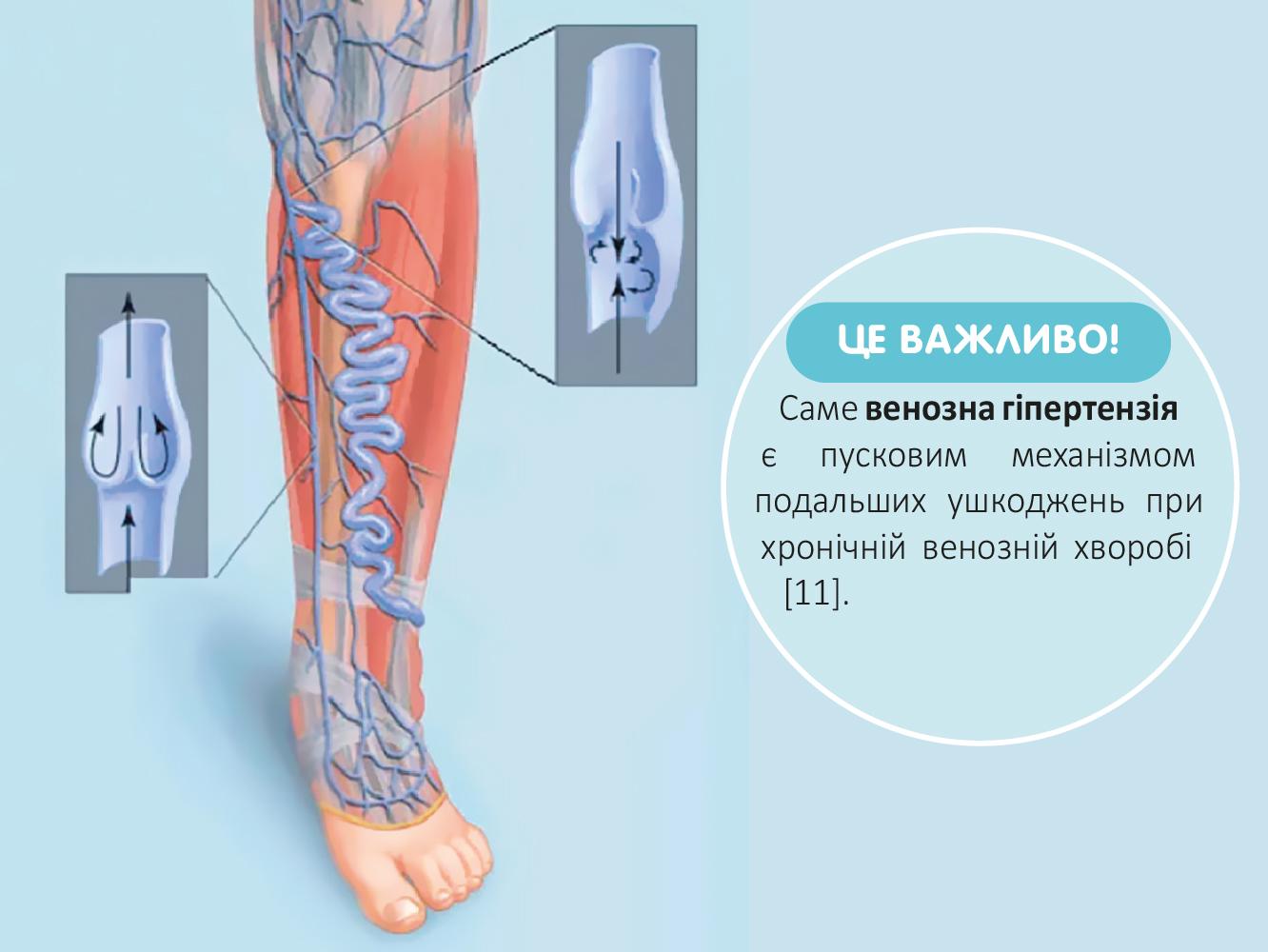 НОРМОВЕН 1000 — доказове рішення при важкості в ногах і геморої